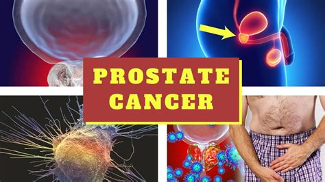 anu ang sanhi na sakit ng enlarge prostate